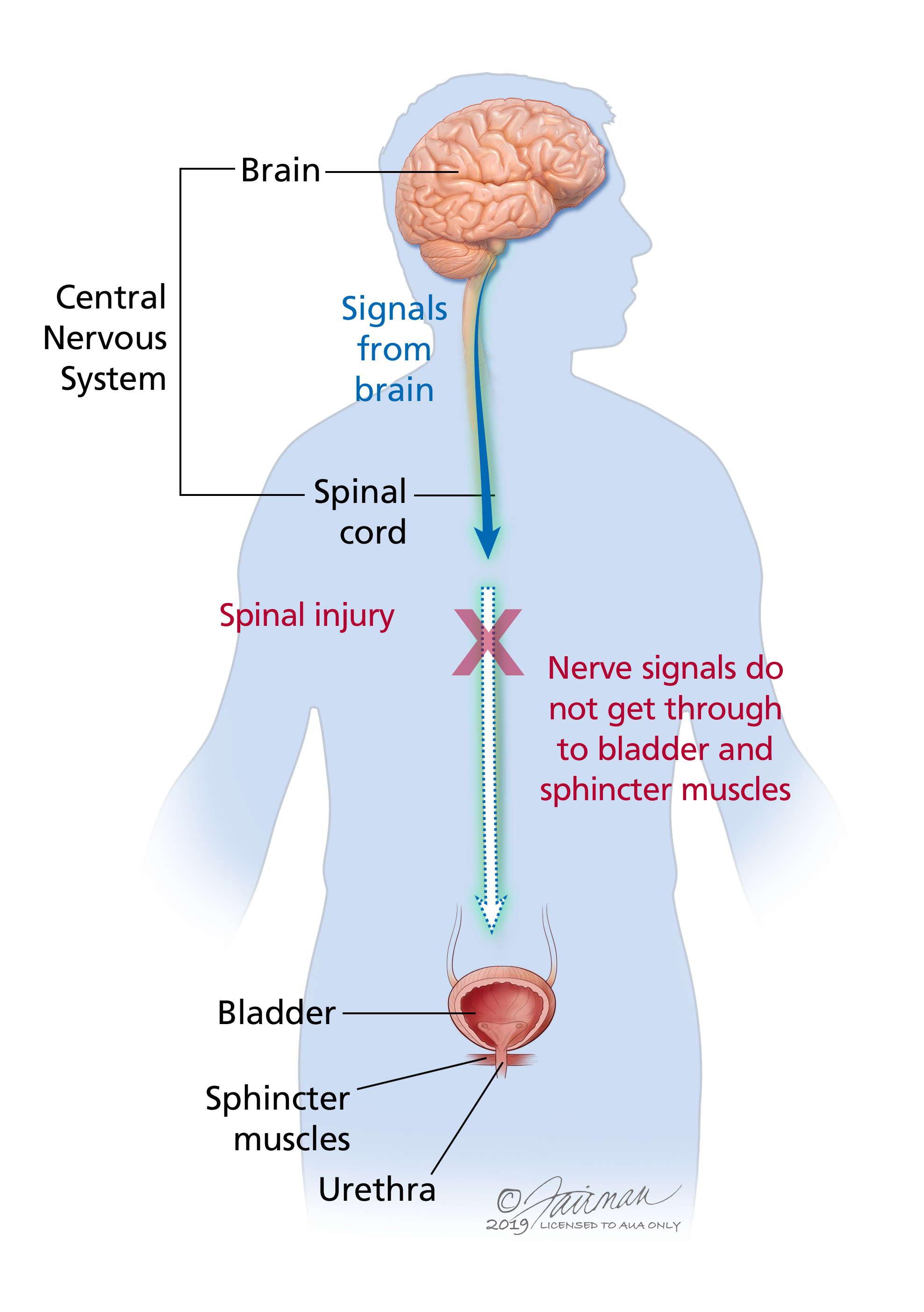 Neurogenic Bladder