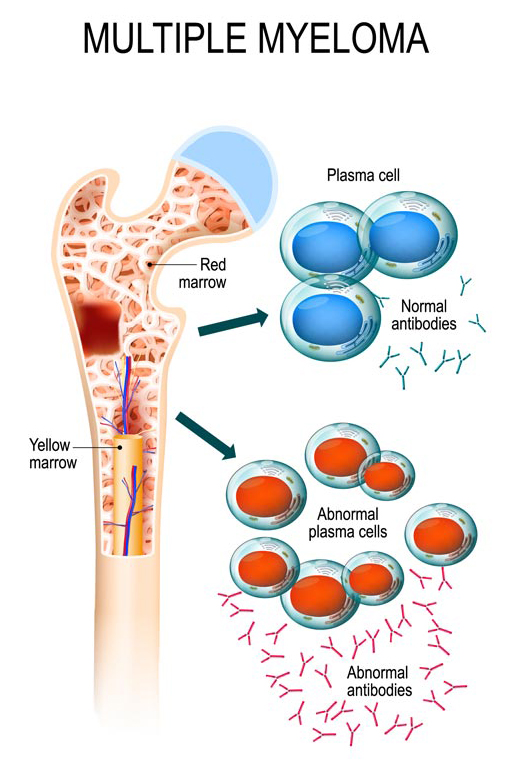 Multiple Myeloma